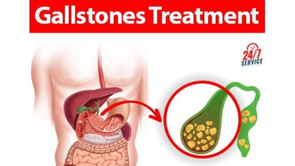 Gallstones